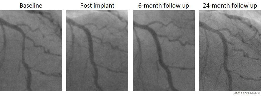 Fantom Case: Angiographic follow up from FANTOM II