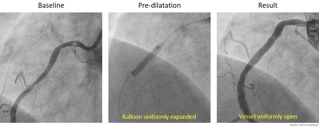 Example of Successful Pre-dilatation