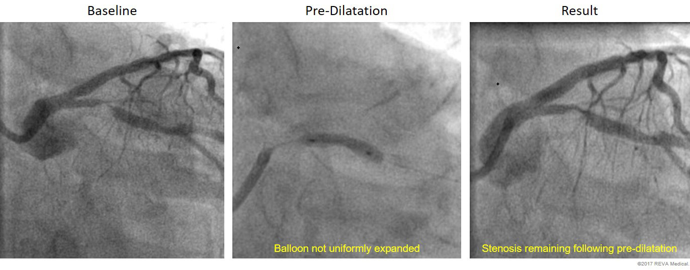 Example of In-adequate Pre-dilatation