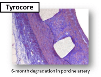 Tyrocore